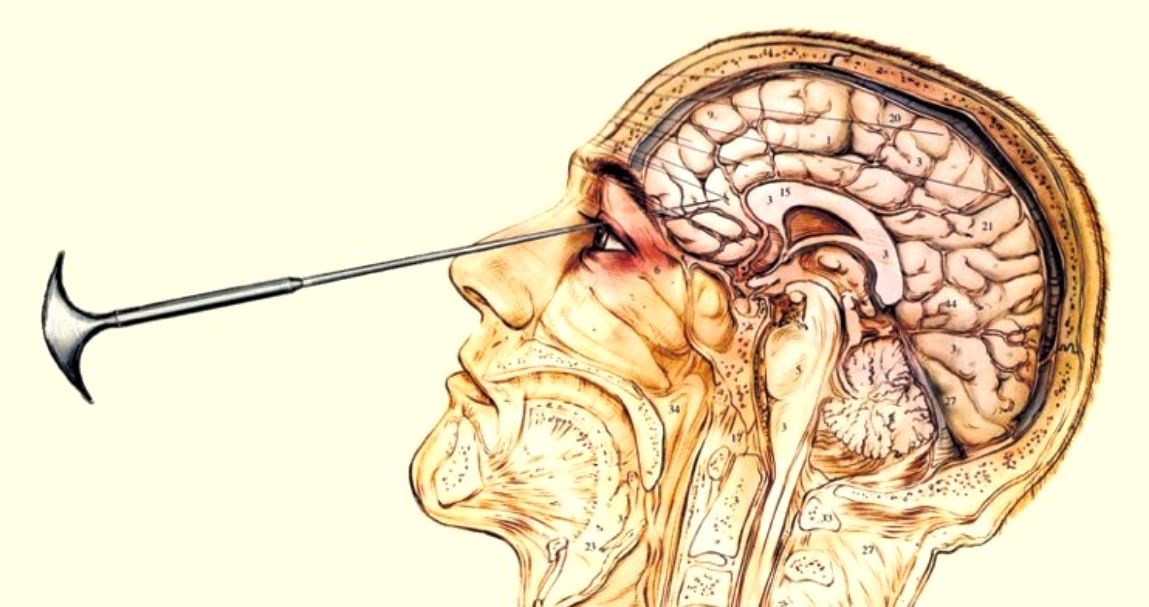 lobotomy